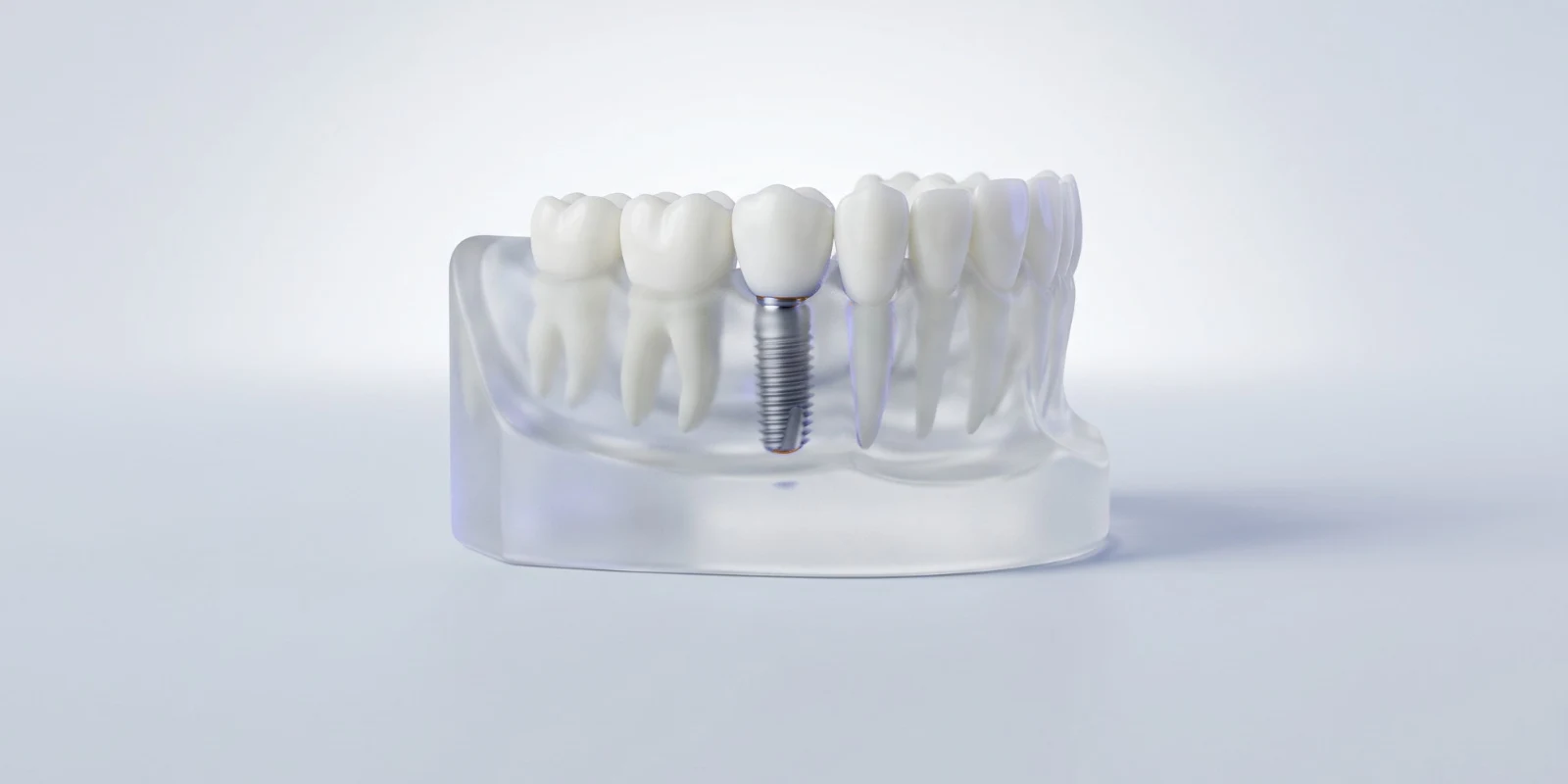 Şeffaf çene modelinde implant ve kron