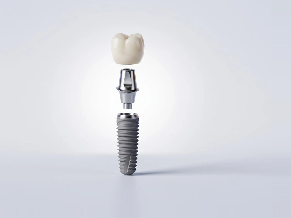 Parçalarına ayrılmış diş implantı: titanyum vida, abutment ve zirkonyum kron